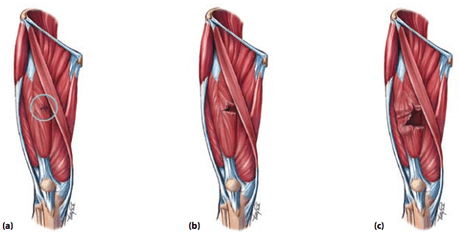 hamstring injury grading