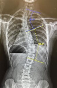 scoliosis xray