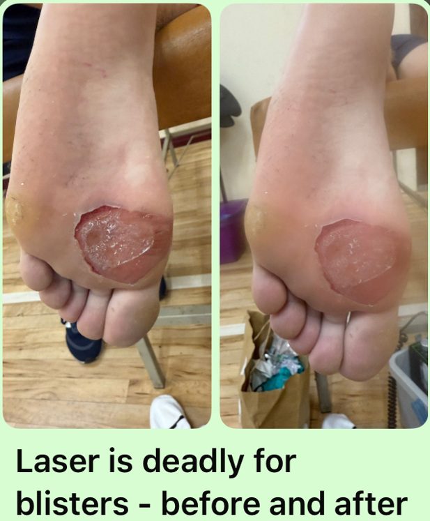 blister treatment before and after